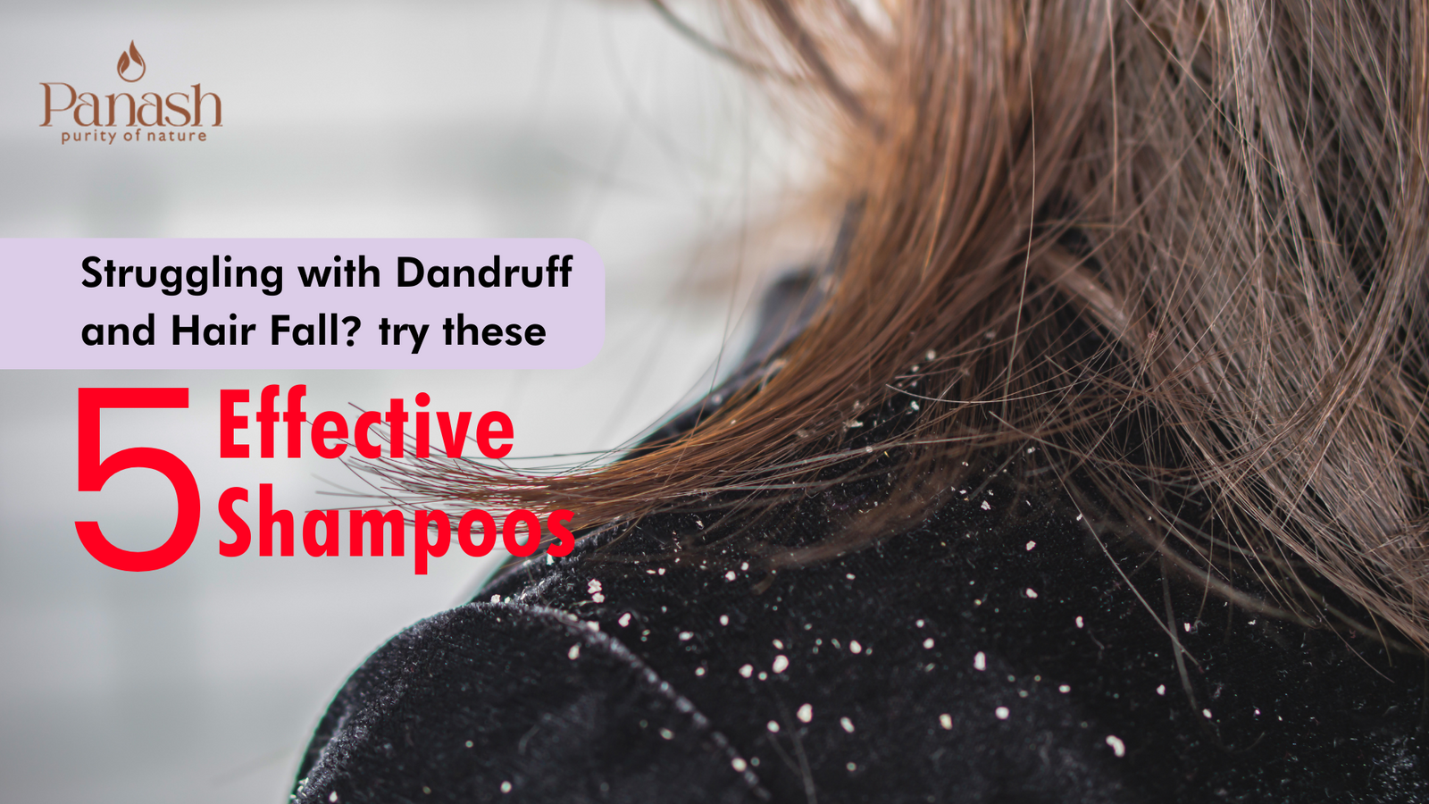 Struggling with Dandruff and Hair Fall